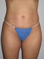 Tummy Tuck