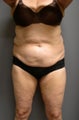 Tummy Tuck