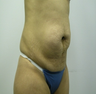 Tummy Tuck