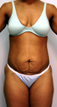 Tummy Tuck