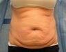 Tummy Tuck