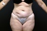 Tummy Tuck