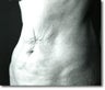 Tummy Tuck
