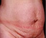 Tummy Tuck