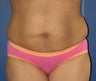 Tummy Tuck