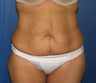 Tummy Tuck