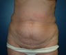 Tummy Tuck