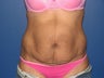 Tummy Tuck