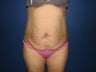 Tummy Tuck