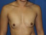 Breast Augmentation