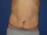 Male Tummy Tuck