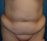 Tummy Tuck
