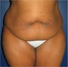 Tummy tuck (abdominoplasty)