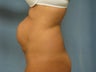 Tummy Tuck
