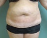 Abdominoplasty with Liposuction to Hips and Abdomen