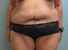 Abdominoplasty with Liposuction to Hips