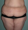 Abdominoplasty with Liposuction to the Hips