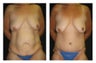 Tummy Tuck