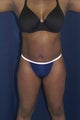 Abdominoplasty and liposuction to flanks