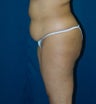 Abdominoplasty, liposuction to flanks and breast reduction