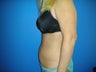 Tummy Tuck