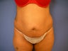 Tummy Tuck