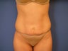 Tummy Tuck