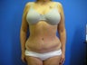 Tummy Tuck