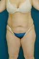 Abdominoplasty with liposuction to flanks and inner thighs