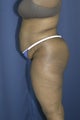 Abdominoplasty and liposuction to flanks