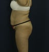Abdominoplasty and liposuction to flanks and scapular