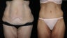 Tummy Tuck