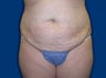 Tummy Tuck