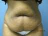 Tummy Tuck