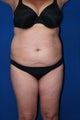 Tummy Tuck