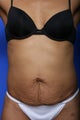 Tummy Tuck
