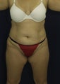 Tummy Tuck and lipo to flanks