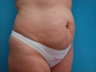 Tummy Tuck