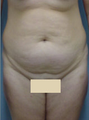 Tummy Tuck