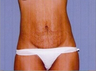 Tummy Tuck