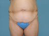 Tummy Tuck