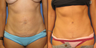 Tummy Tuck