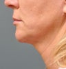 Ulthera Laser Skin Tightening
