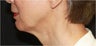 Ultherapy