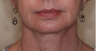 Ultherapy