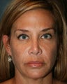 Ultherapy 