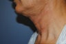 Ultherapy - immediately before and after