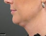 Ulthera Laser Skin Tightening