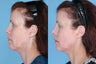 Ulthera Full Face and Neck