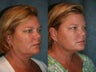 Ultherapy